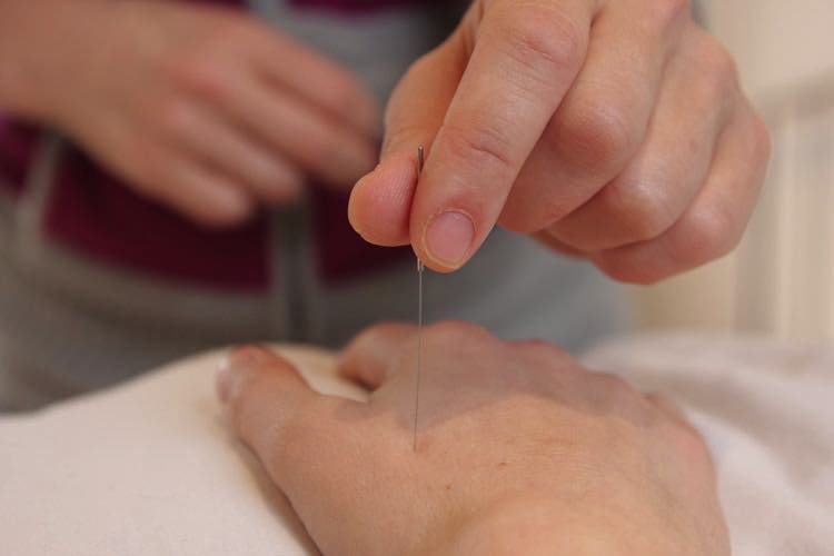 Acupuncture Treatment